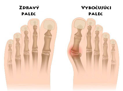 Silikonový prstový fixátor pro zmírnění bolesti nohou